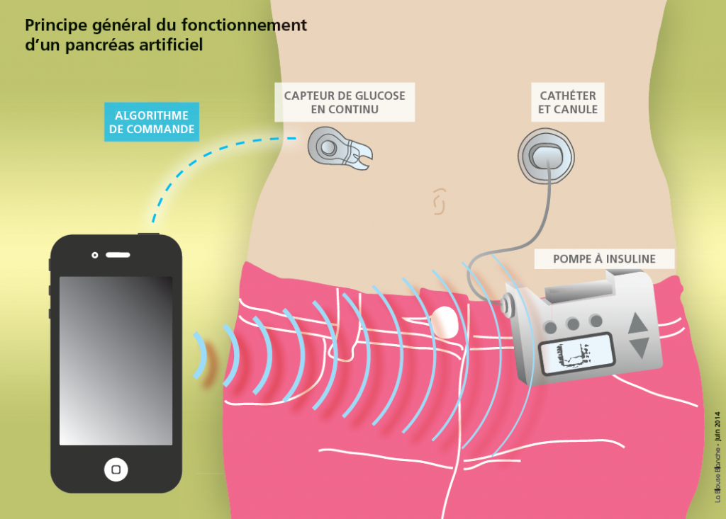 Pancreas artificiel