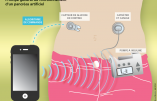Après le cœur, le pancréas artificiel ! Les greffes d’organes vont-elles disparaître ?